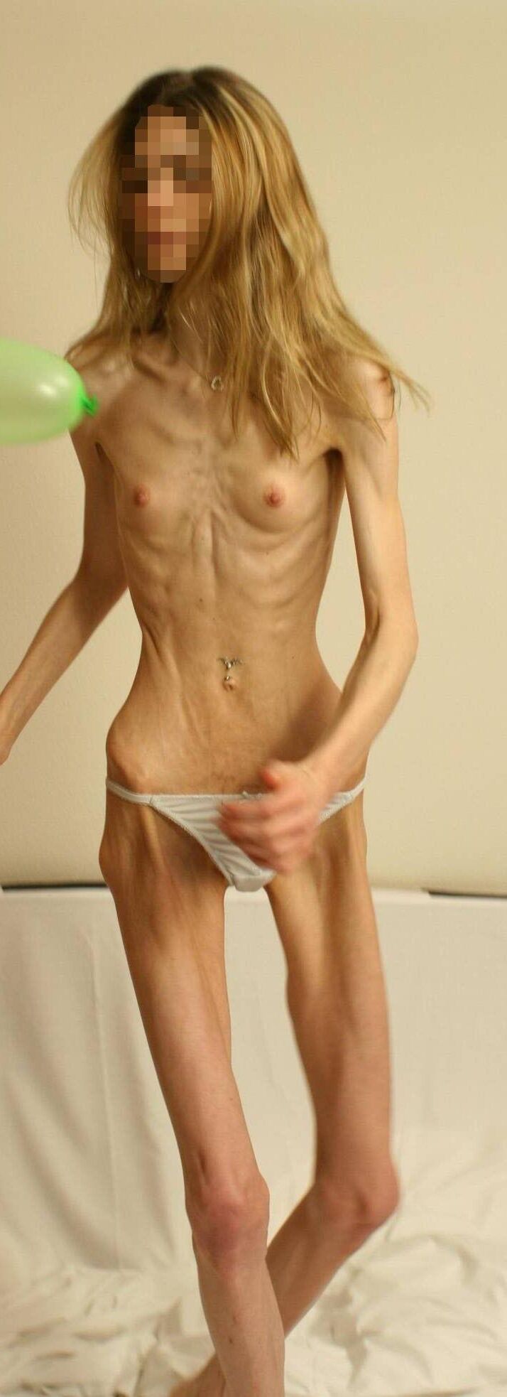 拒食症
